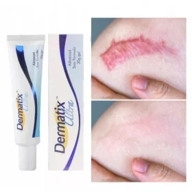   Dermatix Ultra silikonski gel za brazgotine 15 g - zdravljenje in preprečevanje hipertrofičnih in keloidnih brazgotin